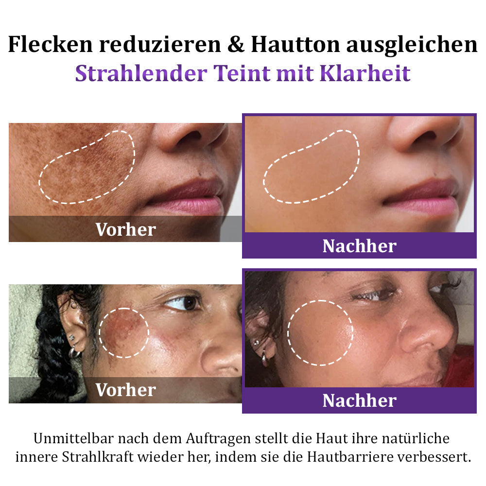 💜✅𝐊𝐁𝐕 𝐙𝐮𝐥𝐚𝐬𝐬𝐮𝐧𝐠 | 𝐄𝐝𝐢𝐉𝐨𝐧𝐚𝐡®𝐄𝐏𝐈𝐆𝐋𝐎𝐖 𝐌𝐞𝐥𝐚𝐧𝐄𝐗 𝐅𝐨𝐫𝐭𝐬𝐜𝐡𝐫𝐢𝐭𝐭𝐥𝐢𝐜𝐡𝐞 𝐀𝐧𝐭𝐢-𝐇𝐲𝐩𝐞𝐫𝐩𝐢𝐠𝐦𝐞𝐧𝐭𝐢𝐞𝐫𝐮𝐧𝐠𝐬 𝐂𝐫𝐞𝐦𝐞